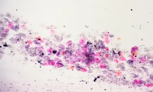 Hai loại virus làm tăng nguy cơ ung thư khoang miệng Hai loại virus làm tăng nguy cơ ung thư khoang miệng
