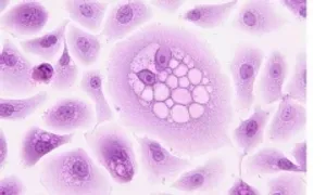 Điều trị ung thư da bằng virus Herpes Điều trị ung thư da bằng virus Herpes