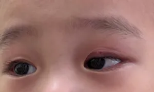 Mắt bé trai sưng húp do nhiễm khuẩn tụ cầu vàng