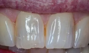 Rạn men răng Rạn men răng